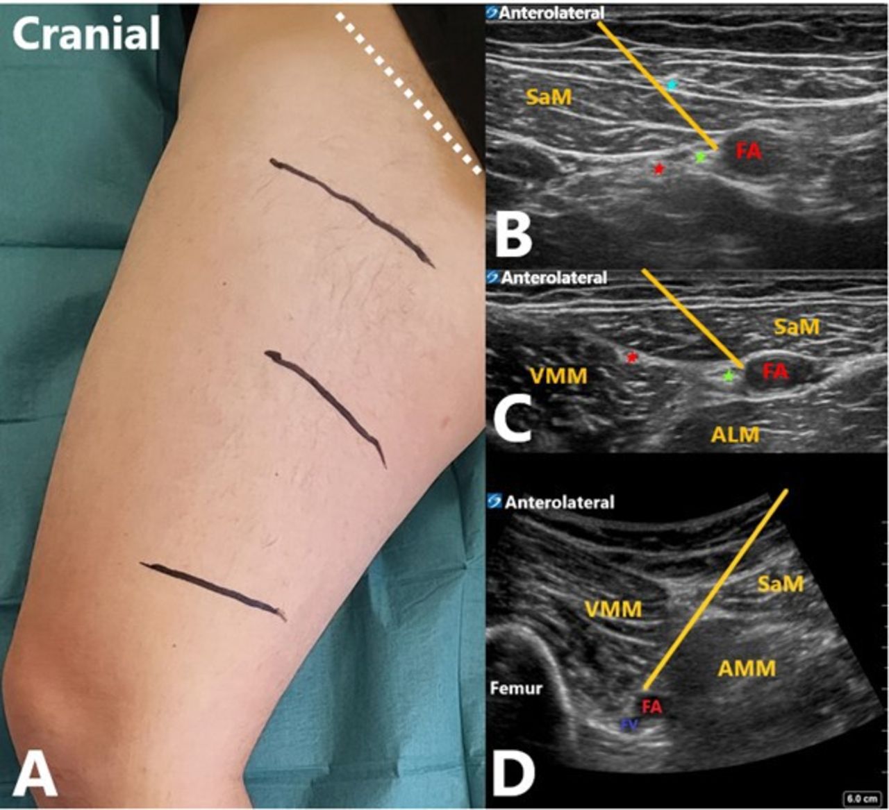 Popliteal Nerve Block Volume Popliteal Nerve Block Volume